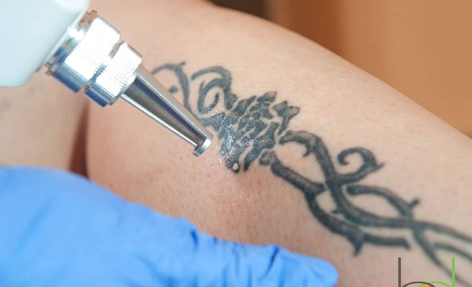 The Science Behind Tattoo Removal